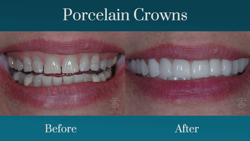 all porcelain crowns before an